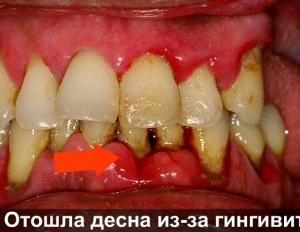 Iš danties iškrito dantenos: kokių veiksmų imtis?